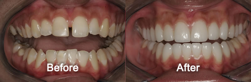 Porcelain Veneers - Before and After
