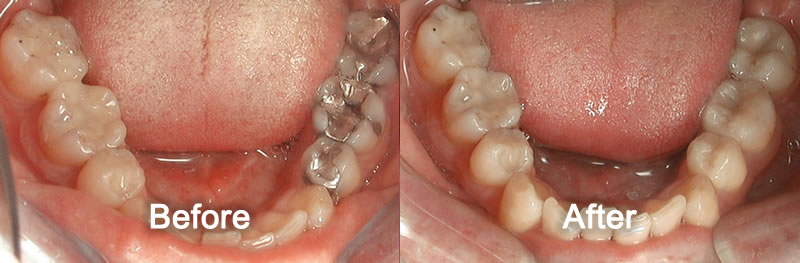 Markham Dentist - White Fillings - Before and After Photos