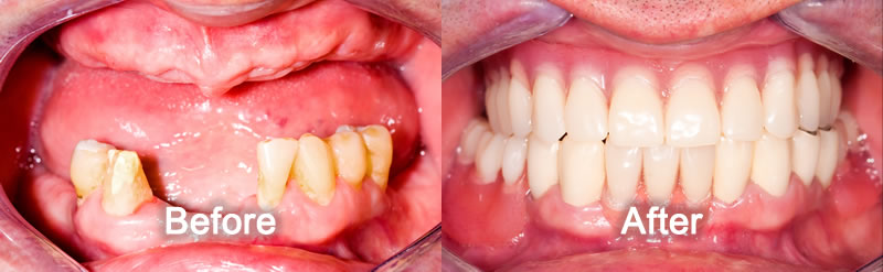 dentures before & after Markham