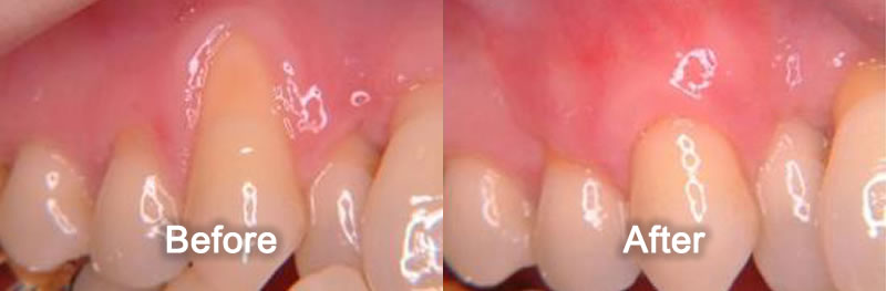 Gum Grafting Before & After Markham