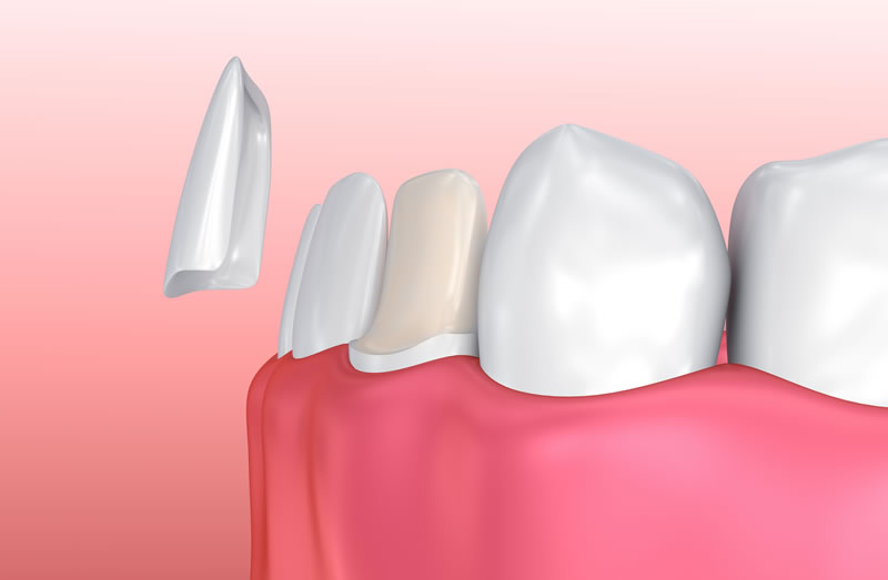 Porcelain Veneers Markham Dentist