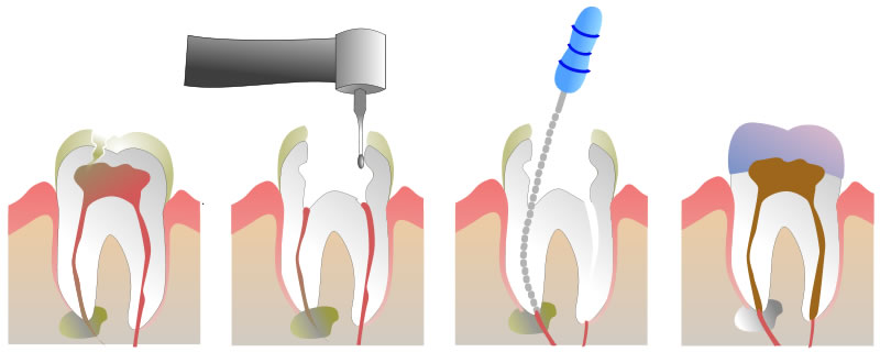 Root Canal Therapy - diagram of procedure