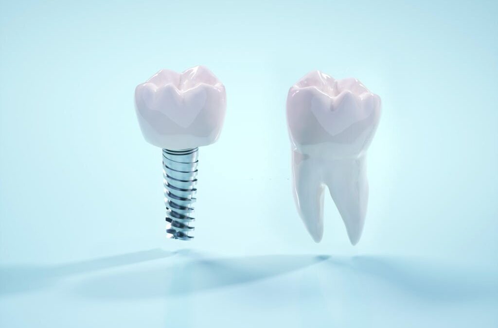 Tips for Taking Care of Your Dental Bridge