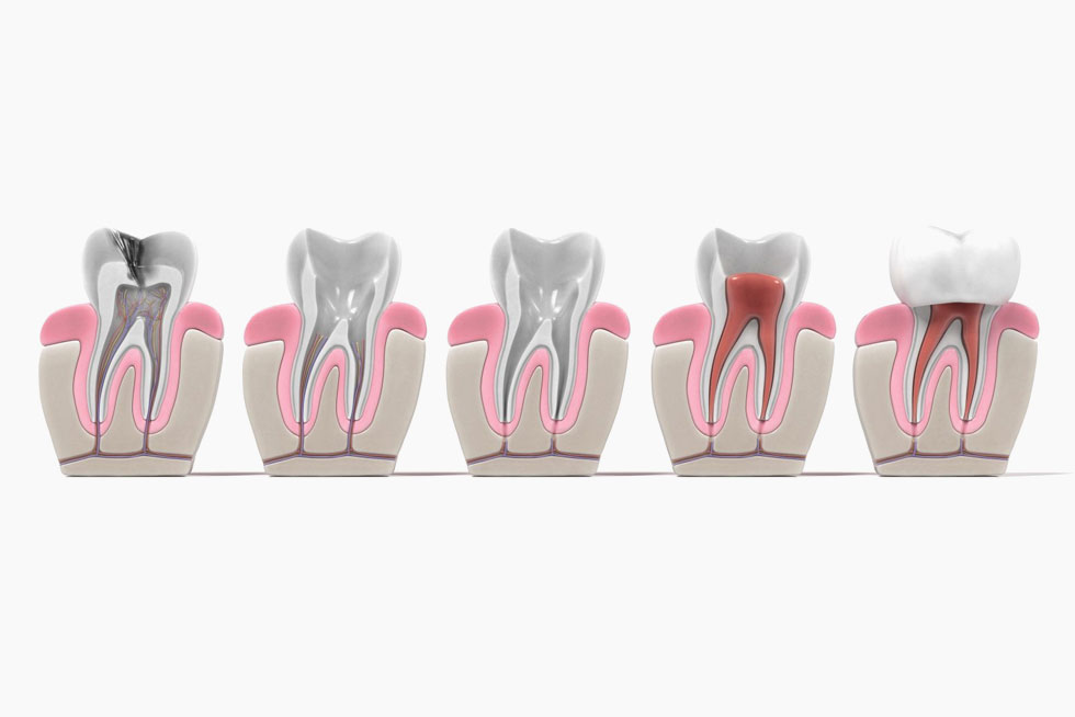 Root Canal Therapy in Markham: Saving Your Tooth and Relieving Pain